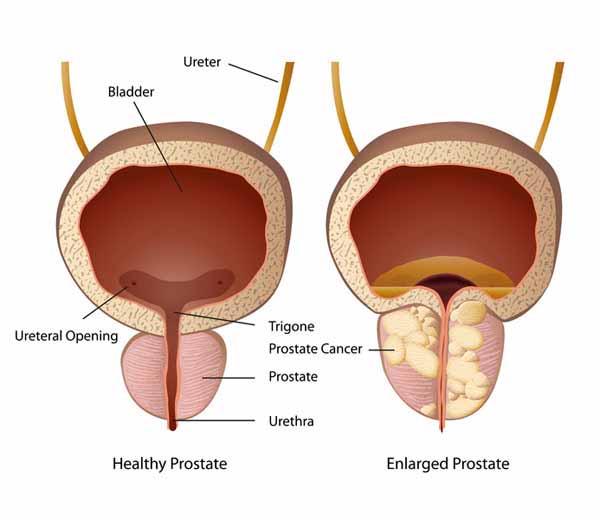 prostatakrebs