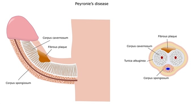 Peyronie-Erkrankung